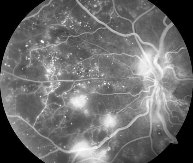 DIABETIC RETINOAPTHY: STAGES, SIGNS, COMPLICATIONS AND MANAGEMENT