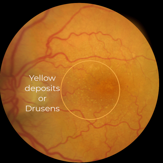 Age-Related Macular Degeneration Or Amd: Types, Symptoms, Diagnosis And ...