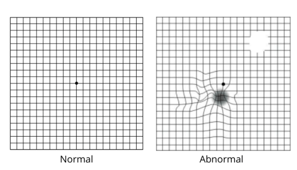 Age-Related Macular Degeneration Or Amd: Types, Symptoms, Diagnosis And ...