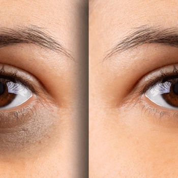 UNDER-EYE DARK CIRCLES: KNOW WHY YOU HAVE THEM BEFORE HOW YOU CAN TREAT THEM