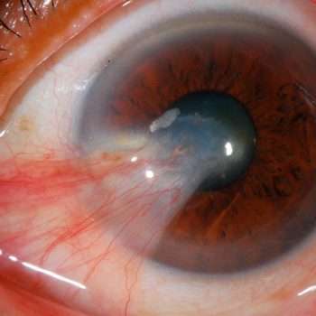 PTERYGIUM OR SURFER’S EYE: SYMPTOMS, MANAGMENT AND MORE