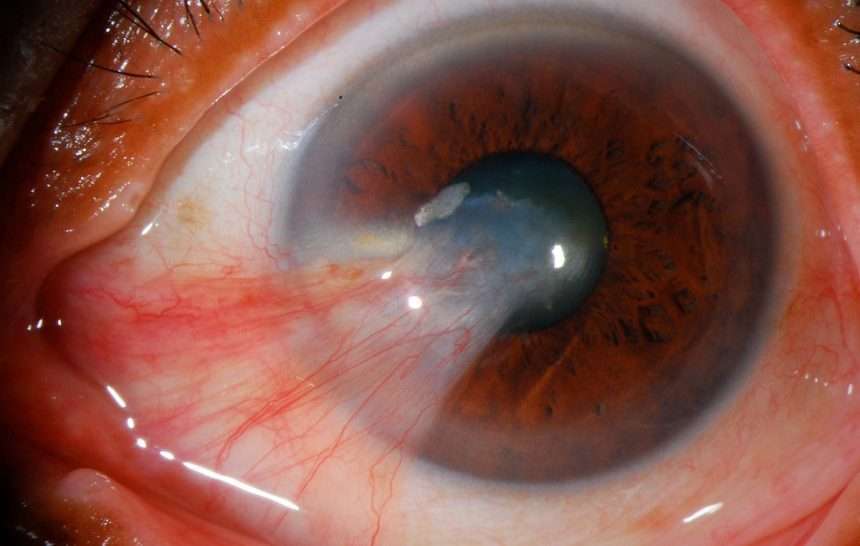 PTERYGIUM OR SURFER’S EYE: SYMPTOMS, MANAGMENT AND MORE