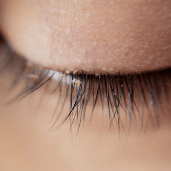 BLEPHARITIS TYPES, CAUSES AND TREATMENT