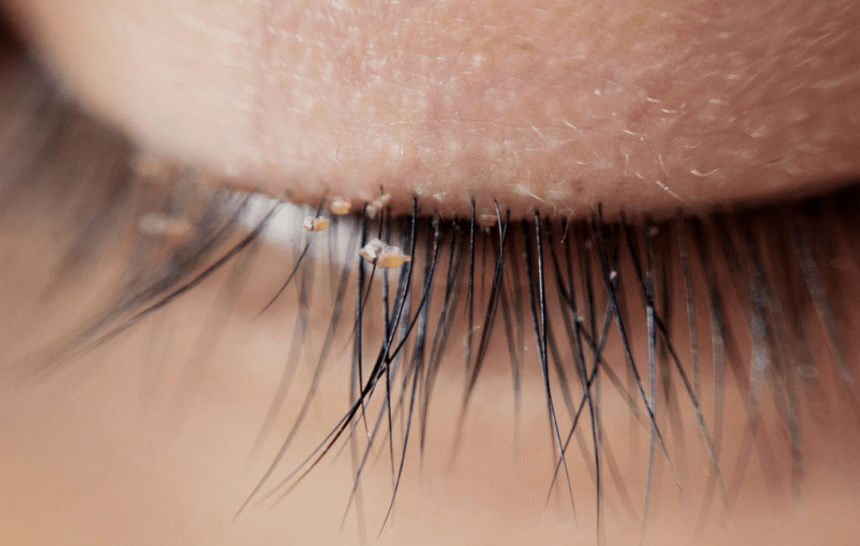 BLEPHARITIS TYPES, CAUSES AND TREATMENT