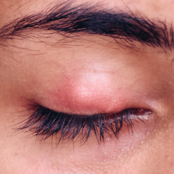 IS THAT A STYE? IS THAT A HORDEOLUM? IT’S A CHALAZION!