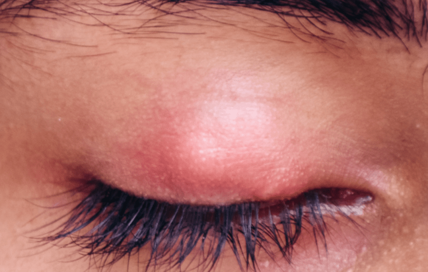 IS THAT A STYE? IS THAT A HORDEOLUM? IT’S A CHALAZION!