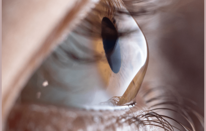 KERATOCONUS: DIAGNOSIS AND MANAGEMENT