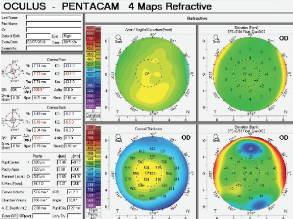 Keratoconus: Diagnosis And Management - Simpleeyedeas