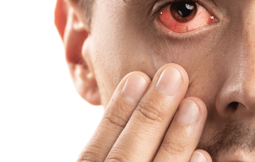 7 FACTS YOU NEED TO KNOW ABOUT CONJUNCTIVITIS