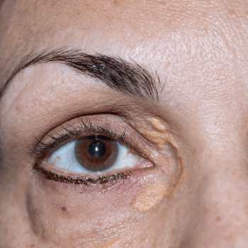 XANTHELASMA- WHAT YOU NEED TO KNOW ABOUT THAT YELLOW BUMP ON YOUR EYELID