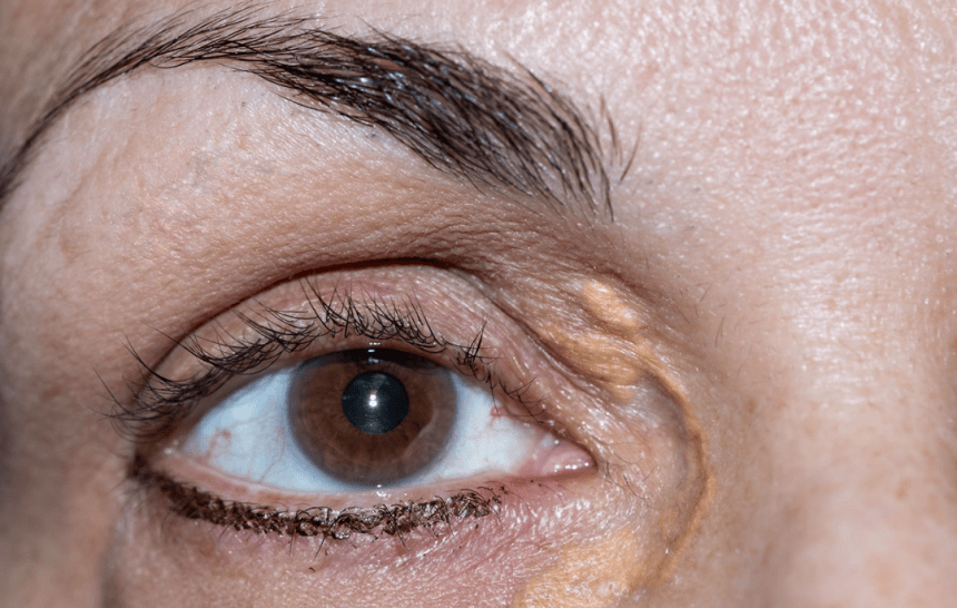 XANTHELASMA- WHAT YOU NEED TO KNOW ABOUT THAT YELLOW BUMP ON YOUR EYELID