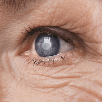 CATARACT: RISK FACTORS AND PREVENTION TIPS