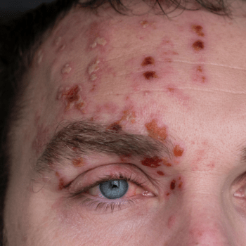 HOW TO RECOGNIZE SHINGLES AROUND THE EYE: HERPES ZOSTER OPHTHALMICUS