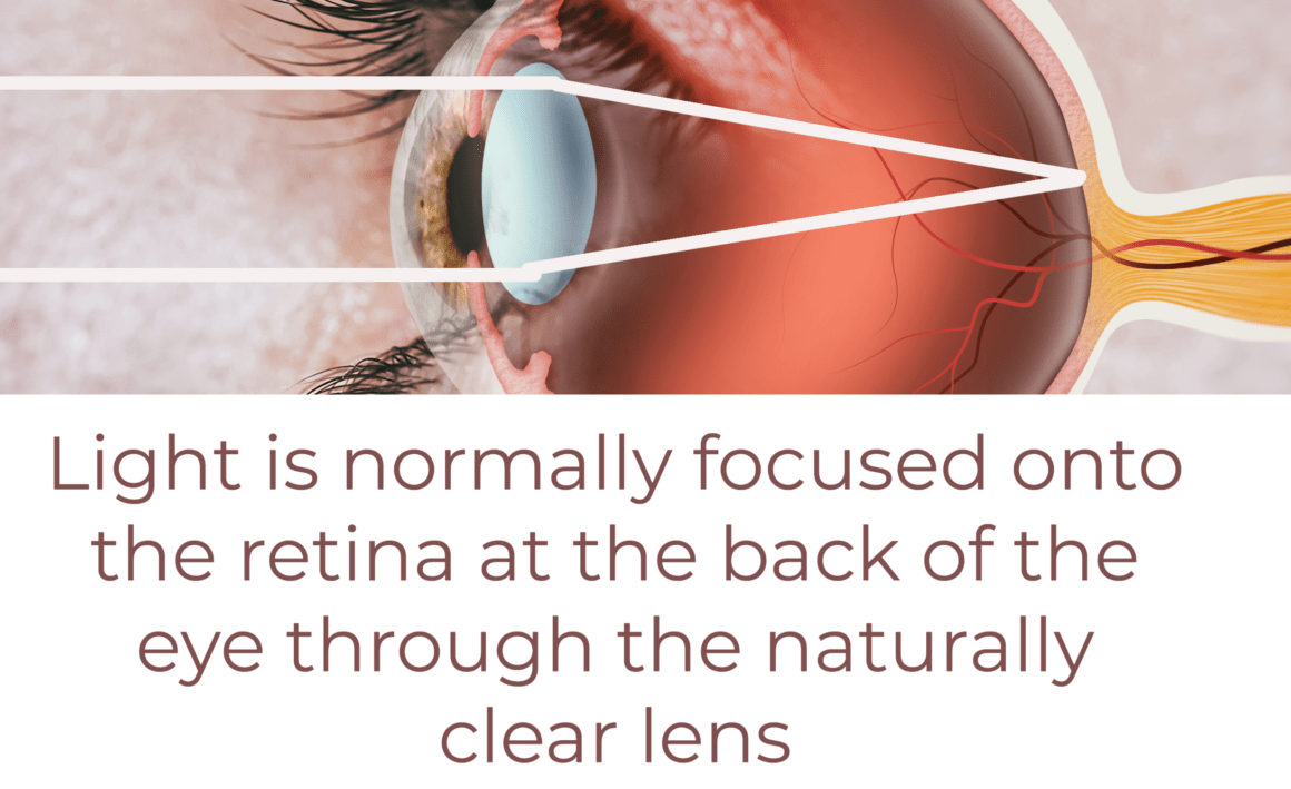 Glaucoma Vs Cataract Understanding The Differences Simpleeyedeas